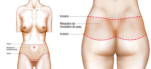 abdominoplastie-circulaire-tunisie