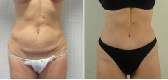 resultat-abdominoplastie-repta