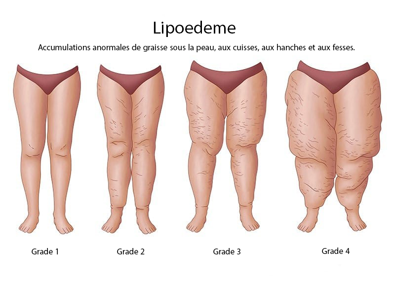 Grades Lipoedeme