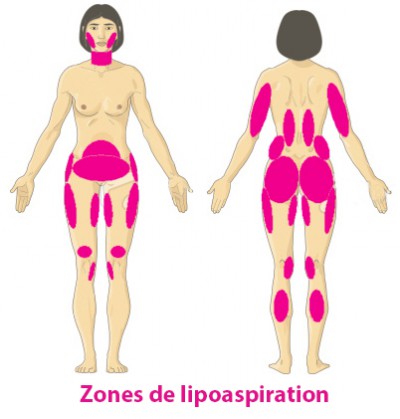 zones liposuccion